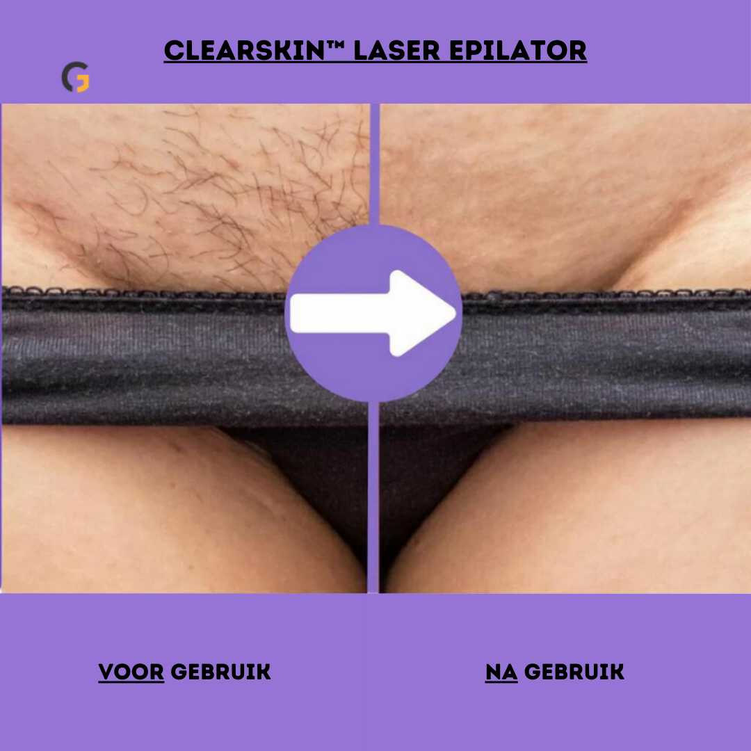 ClearSkin™ Laser Epilator | De ultieme oplossing voor haarverwijdering